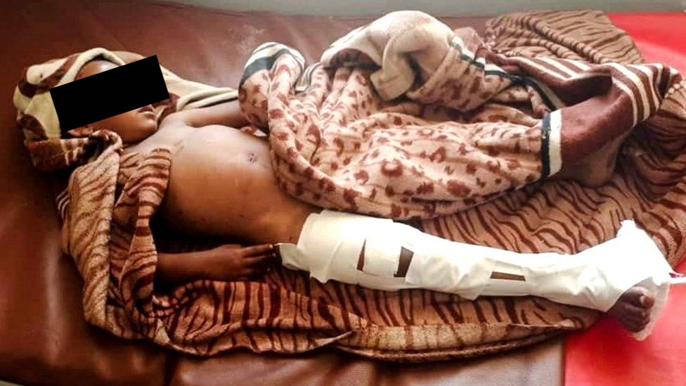 Dedebit Tigray bambino vittima di raid aerei