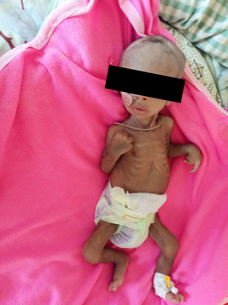 Surafeal Mearig di 3 mesi malnutrito, che pesa 2.3 kg rispetto al suo peso alla nascita di 3.4 kg, si prende cura di essere stato ricoverato all'Ayder Referral Hospital di Mekelle, regione del Tigray, Etiopia, 22 dicembre 2021. REUTERS/Stringer 