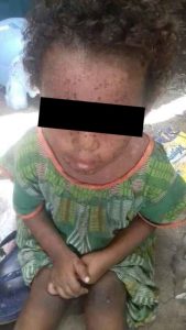 Condizioni Cutanee Di Una Bambina Tigrina Detenuta Nel Campo Di Semera - Afar Senza Supporto Medico